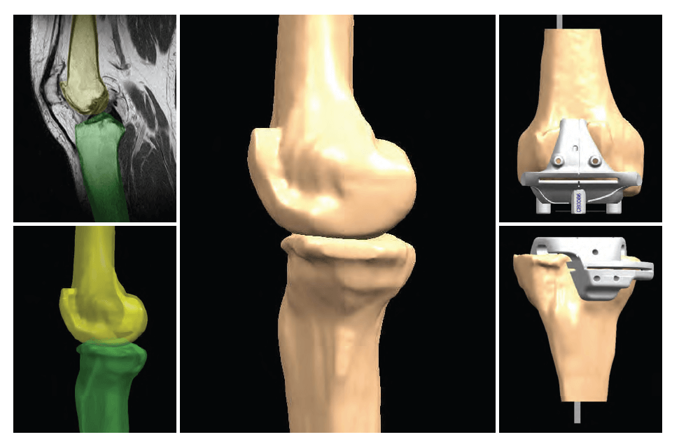 Εικόνα 6: Μαγνητική τομογραφία γόνατος, 3D μοντέλο και εξατομικευμένοι οδηγοί κοπής.