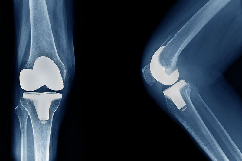 Εικόνα 9: Μετεγχειρητικές ακτινογραφίες εξατομικευμένης αρθροπλαστικής γόνατος.