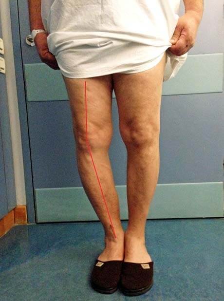 Εικόνα 10: Ραιβό γόνατο λόγω οστεοαρθρίτιδας