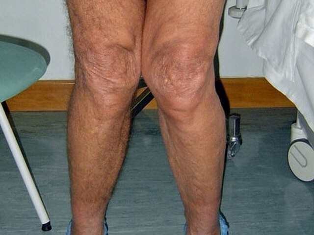 Εικόνα 11: Παραμόρφωση γόνατος σε βλαισότητα ως αποτέλεσμα σοβαρής αρθρίτιδας