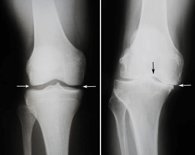 Εικόνα 12:(Αριστερά) Σε αυτήν την ακτινογραφία ενός φυσιολογικού γόνατος, ο χώρος μεταξύ των οστών υποδεικνύει υγιή χόνδρο (βέλη). (Δεξιά) Ακτινογραφία ενός παραμορφωμένου από αρθρίτιδα γόνατος που εμφανίζει σοβαρή στένωση του μεσάρθριου διαστήματος (βέλη).